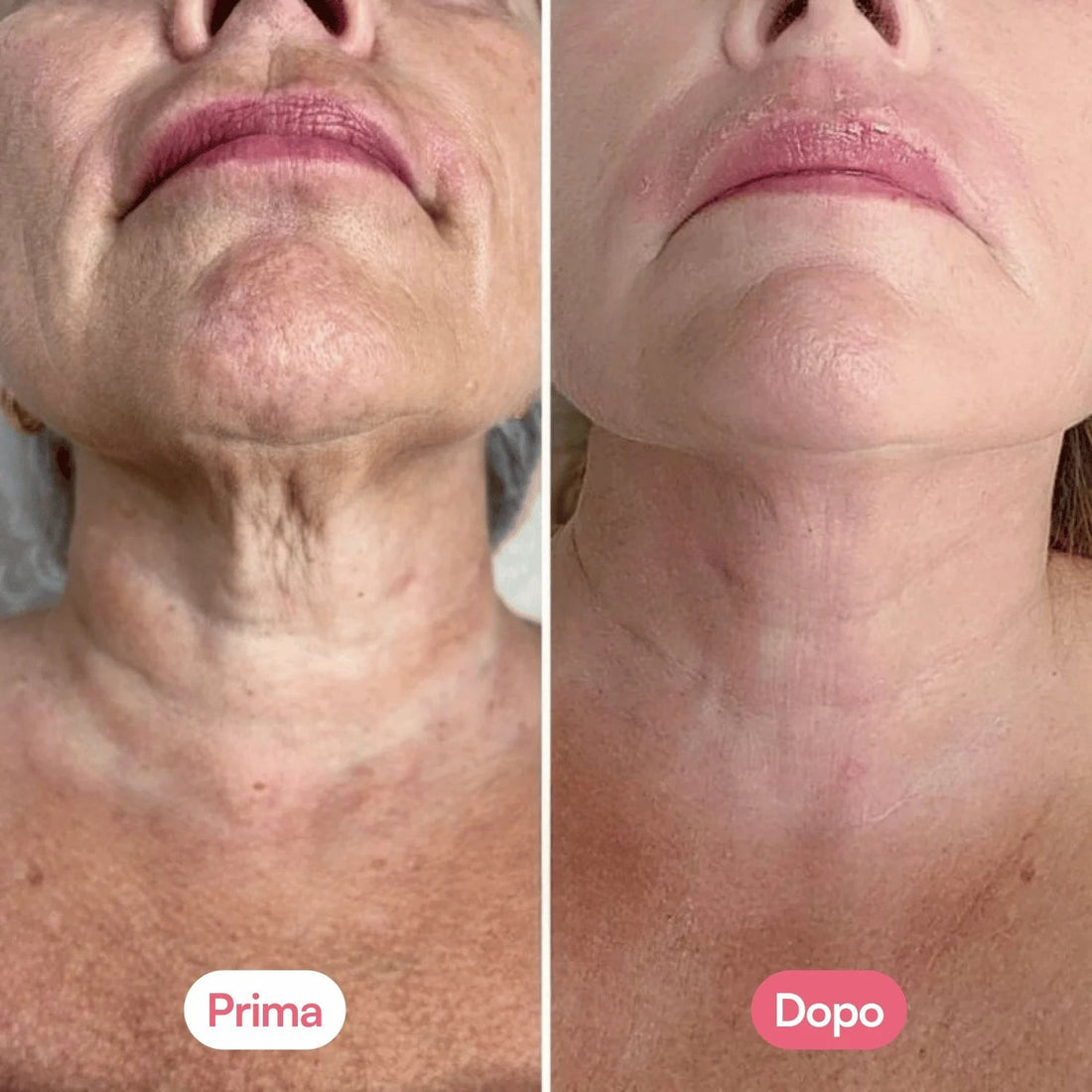 Prima e dopo su collo e décolleté